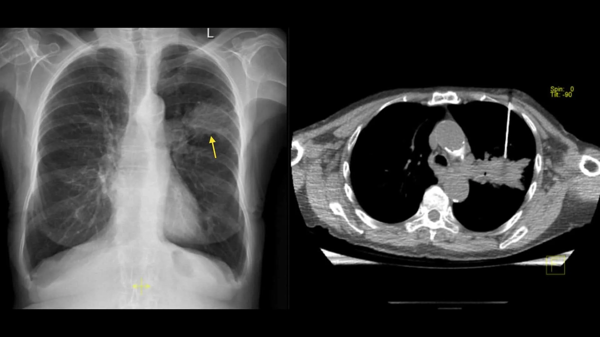 ct-guided-biopsy-&-usg-guided-biopsy