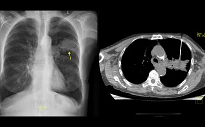 CT-Guided-Biopsy