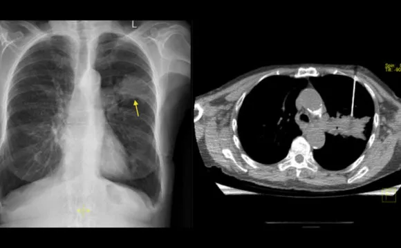 CT Guided Biopsy