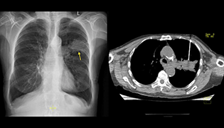 CT Guided Biopsy in Ahmedabad