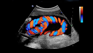 Doppler Ultrasound Imaging