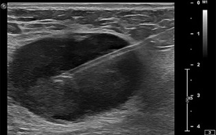 USG-Guided-Biopsy